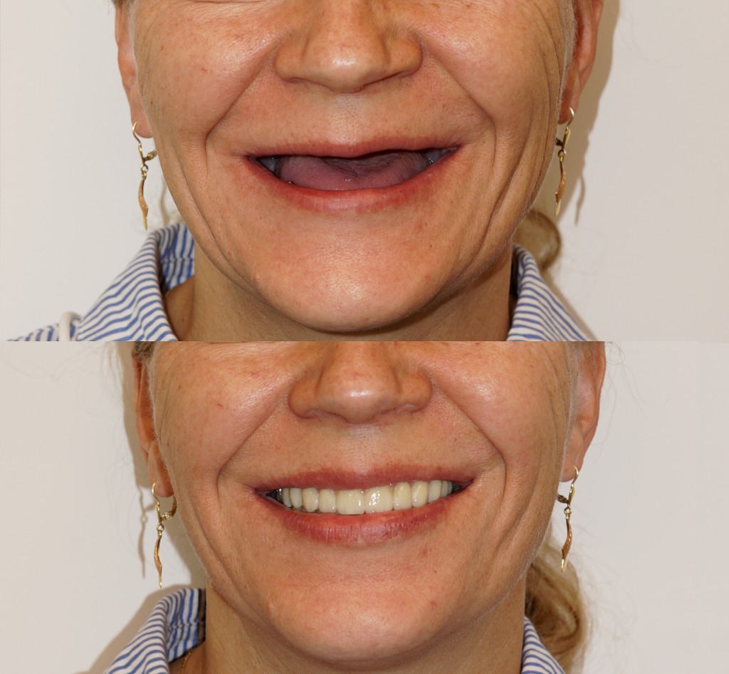 Před a po — All-on-4, výsledek pacienta YES Dental Clinic